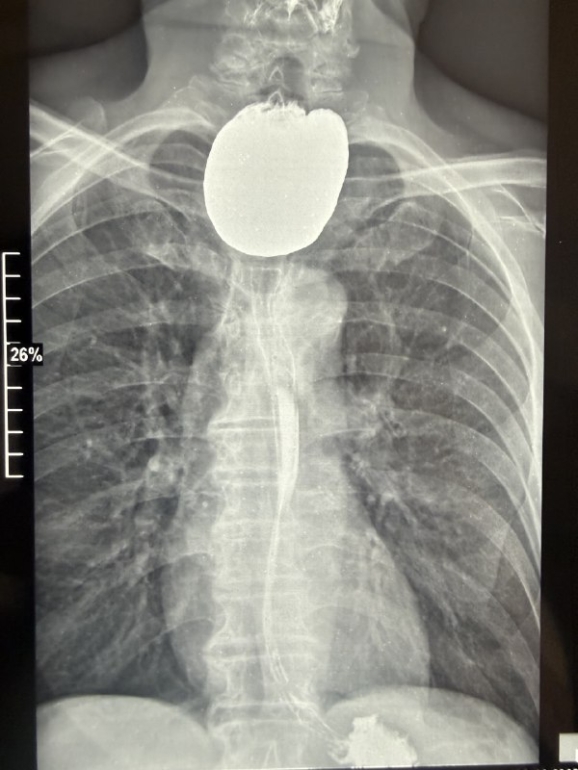 Томские хирурги удалили из пищевода пациента гигантский дивертикул размером с апельсин